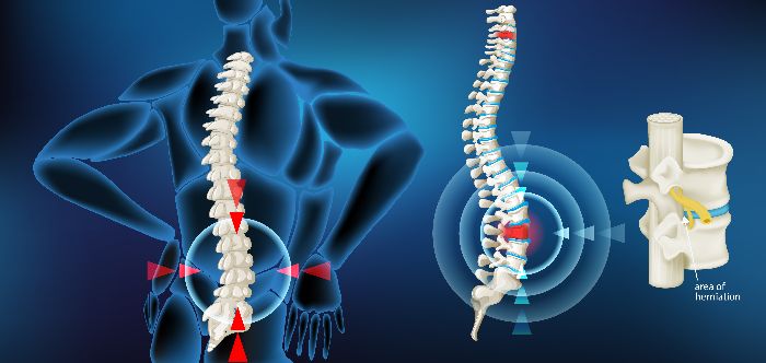 Top Picture - Spinal Cord Injury